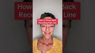 How to Grow Back a Receding Hairline [upl. by Bess835]