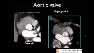 Post Processing Cardiac CT [upl. by Idalia]