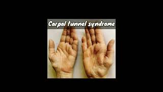 Carpal tunnel syndrome [upl. by Yerga951]