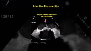 Infective Endocarditis [upl. by Laurice]