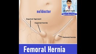 Femoral HerniaFemoral Canal Anatomy Groin HerniaInguinal Hernia SurgeryLap Hernia surgery [upl. by Florine]