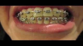 Braces Update  15 One molar elastic [upl. by Arracahs282]