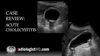 Ultrasound of Acute Cholecystitis [upl. by Wilton550]