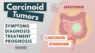 Carcinoid Tumor  Visual Explanation  Symptoms diagnosis treatment prognosis [upl. by Eremahs979]