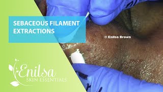 Sebaceous Filament Extractions [upl. by Laidlaw]