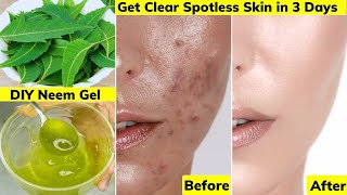 I applied👆🏼this Face Cream Gel on Acne Pimples PigmentationBumpsGot Clear Glowing Skin in 3 Days [upl. by Janaye]