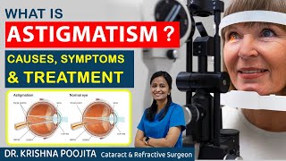 What is Astigmatism  Astigmatism Causes amp Treatment  Dr Krishna poojita  Pixel eye hospital [upl. by Theressa]