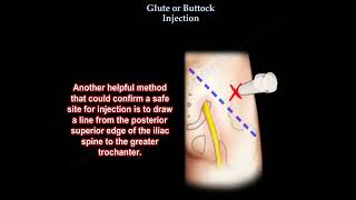 Glute injection buttock injection [upl. by Aziza]