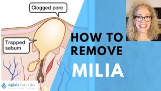 HOW TO REMOVE A MILIA STEP BY STEP  NATURALLY [upl. by Fagaly]