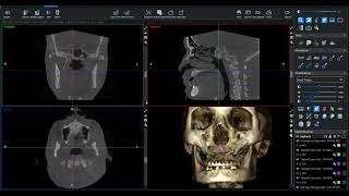 Zygomatic Implant Planning in Romexis 61 [upl. by Snowman]