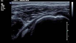 relocating biceps tendon [upl. by Anahcar]