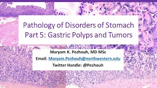 Part 5 Pathology of Gastric Disorders polyps and Tumors [upl. by Wilscam453]