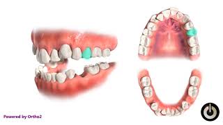 4 Second Premolar Extraction  Dental Braces  Temecula Valley CA [upl. by Eicnahc898]