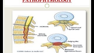 Spinal Stenosis  Medical PowerPoint Presentation [upl. by Anreval]