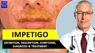 IMPETIGO Definition Description Causes and symptoms Diagnosis amp Treatment of Impetigo [upl. by Niwled509]