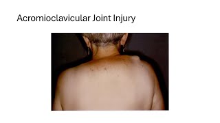 Acromioclavicular Joint Injury [upl. by Rodman528]