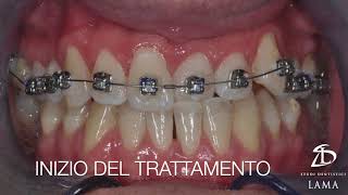 Trattamento ortodontico di Morso Inverso Anteriore con un apparecchio dentale fisso [upl. by Meadows701]