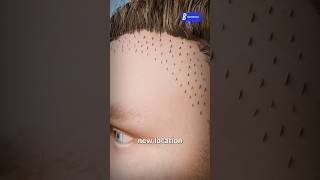 Hair Transplant எப்படி பண்ணுவாங்க doctobooks haircare [upl. by Novyaj]