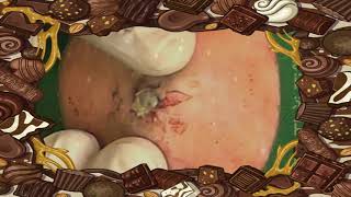 BEST Pimple Popping💖💖 blackheads2023 bestpimplepopping [upl. by Eeraj616]