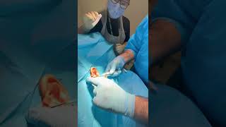 Skin lesion removal [upl. by Gnolb]