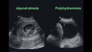 Anomalies of the Fetal Gastrointestinal amp Genitourinary Tracts [upl. by Elik]