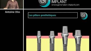 Le lexique implantaire  de limplant à la prothèse [upl. by Brathwaite]