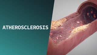 Atherosclerosis  Pathologies [upl. by Janek]