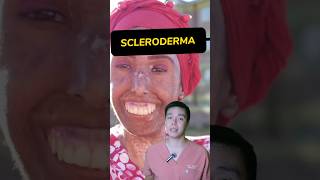 How to operate SCLERODERMA surgeonph viralvideo viralshorts fyp foryou foryoupage scleroderma [upl. by Goodden]