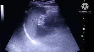 Ureteric stone on Ultrasound [upl. by Regina902]