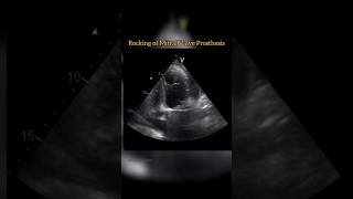 Rocking of Mitral Prosthesis echocardiography cardiology shorts heartcondition [upl. by Steffen]