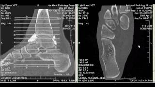 CT Arthrogram of my Ankle 2 April 2009 [upl. by Norrad]