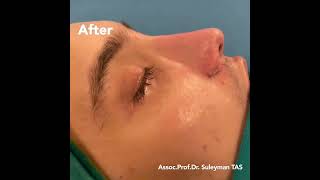 Revision Rhinoplasty  Before and After [upl. by Irroc]