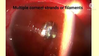 Filamentary keratitis Diagnosis and Treatment [upl. by Sirtaeb]