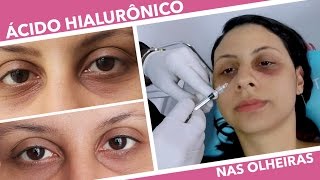 Preenchimento com Ácido Hialurônico Perfectha Finelines  Preço Antes e Depois amp mais [upl. by Rolanda]