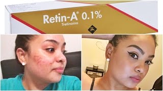 HOW TO GET CLEAR SKIN Get Rid of ACNE  DARK SPOTS Using RETINA Cream [upl. by Yolande966]