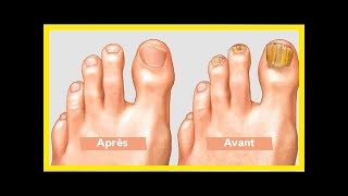 Même les médecins sont étonnés  trempez vos pieds dans ce mélange pour retirer naturellement les c [upl. by Sula121]