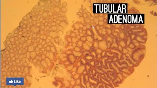 Tubular Adenoma [upl. by Gaul347]