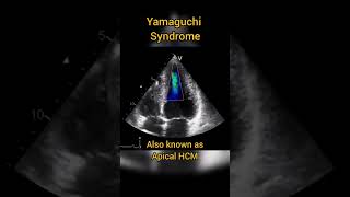 Apical Hypertrophic Cardiomyopathy HCM or Yamaguchi syndrome echocardiography [upl. by Ellerrehs491]