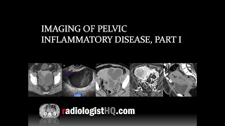 Imaging of Pelvic Inflammatory Disease Part I [upl. by Wiltsey]