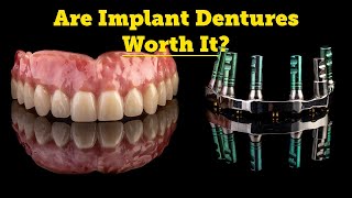 Denture FAQs  Types of Implant Dentures SnapOn Dentures [upl. by Felske247]