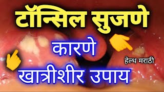 टॉन्सिल सुजणे कारणेटॉन्सिल सुजणे उपाय मराठीtonsillitisdrHukireSV [upl. by Nazario]