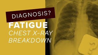 Chest XRay breakdown looking for subtle abnormalities [upl. by Godard921]