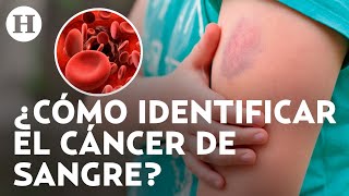 ¿Moretones en la piel sin razón aparente Así puedes saber si se trata de cáncer de sangre [upl. by Yenruoj]