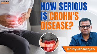 How Serious is Crohns Disease  Crohns Disease Causes Symptoms Treatment  Dr Piyush Ranjan [upl. by Zetes]