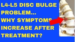 Why Does L4 L5 Disc Bulge Symptom Increase After Treatment  Answered by Chiropractor in Vaughan [upl. by Clarke]