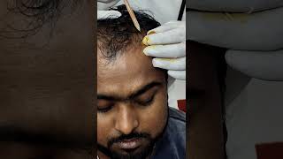 hair loss treatment Hair regrowthlow price prp and GFC treatment  clinic9734984030youtubereel [upl. by Karlie]