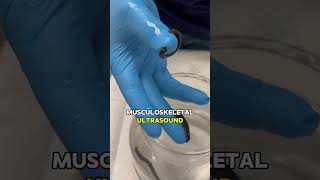 Leech Therapy for Shoulder Pain [upl. by Aleda219]