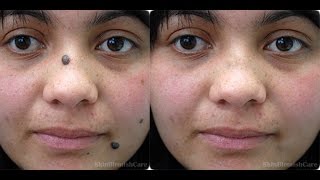 Remove mole and marking from your face and make your skin clear in Photoshop  2 ways [upl. by Laehcym334]