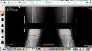 Full length Xrays by stitching in osirix [upl. by Naghem937]