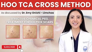 TCA CROSS METHOD FOR ICE PICK SCARS [upl. by Ymmot]